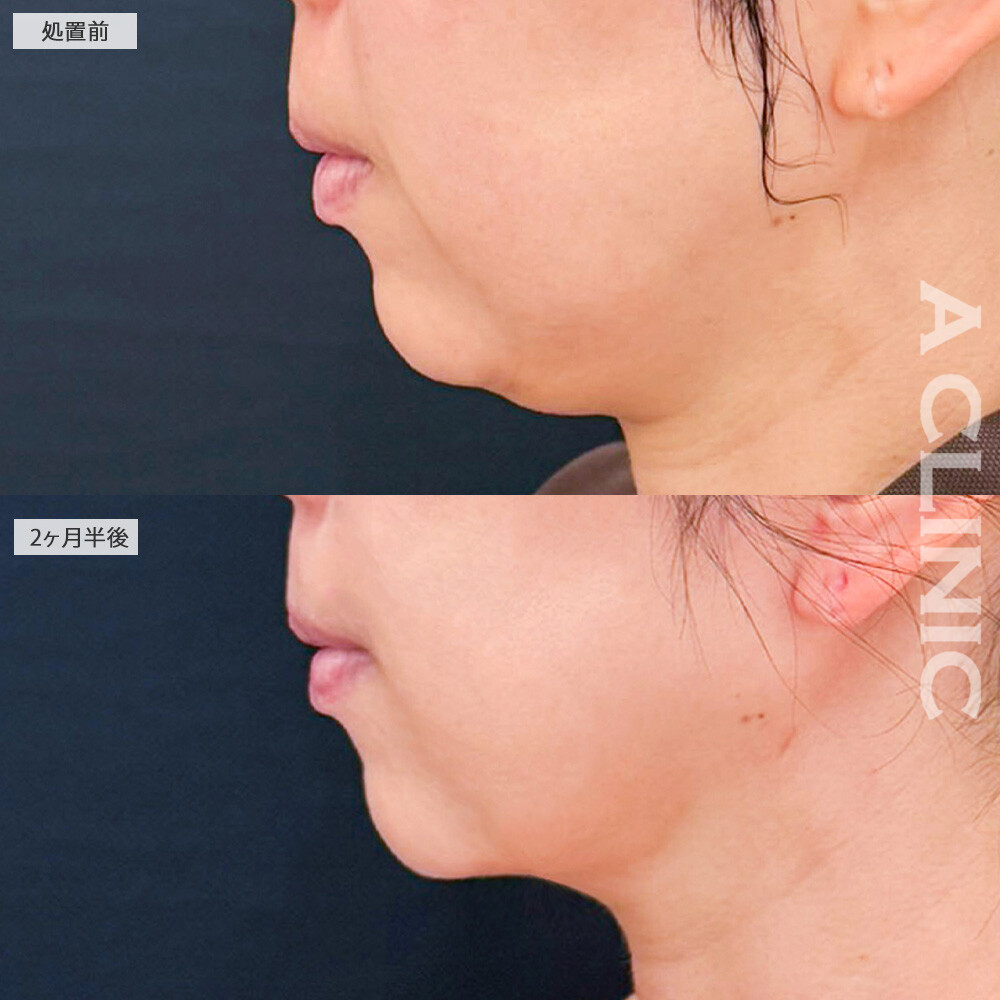 1day小顔脂肪吸引とナゾラビアルファット除去術で見違える程輪郭が変化しました！こちら処置前から2ヶ月半後の症例です(30代女性)