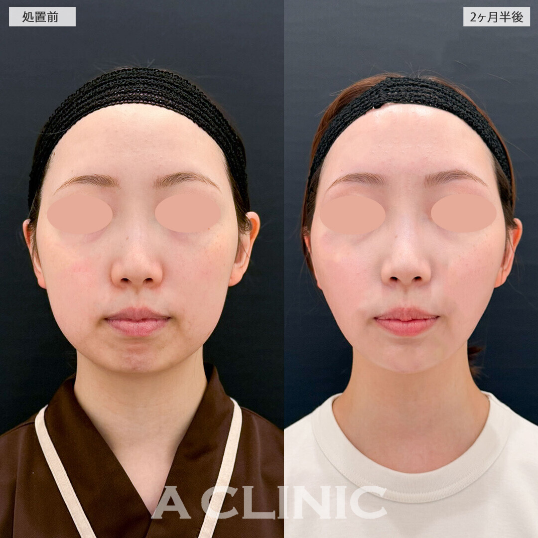 1day小顔脂肪吸引と複合施術でどこから見てもひと回り小顔にアップデート！こちら処置前と2ヶ月半後の症例です(20代女性)