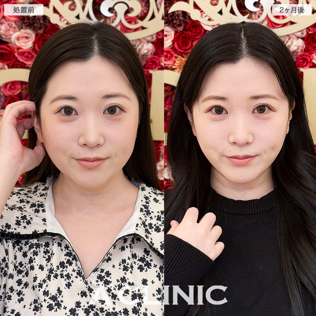 1day小顔脂肪吸引で下を向いた時に気になっていた顎下の脂肪が無くなりました！処置前と2ヶ月後の症例です(30代女性)