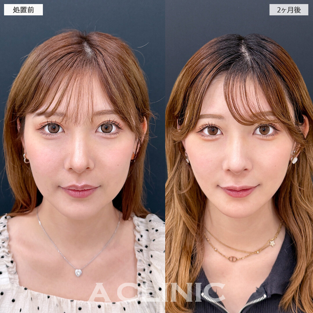 お顔の脂肪吸引で輪郭が整い加工後のようなフェイスラインに！1day小顔脂肪吸引の処置前と2ヶ月後の症例です(30代女性)