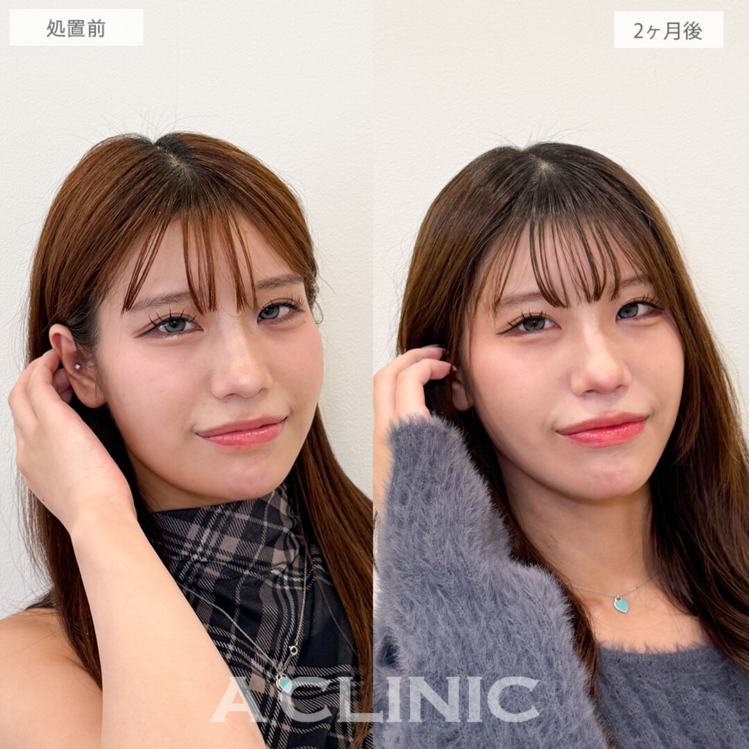 1day小顔脂肪吸引でお顔の余白が減って他撮りも盛れる！こちら処置前と2ヶ月後の症例です(20代女性)
