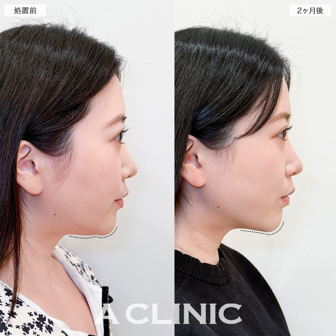 1day小顔脂肪吸引で下を向いた時に気になっていた顎下の脂肪が無くなりました！処置前と2ヶ月後の症例です(30代女性)