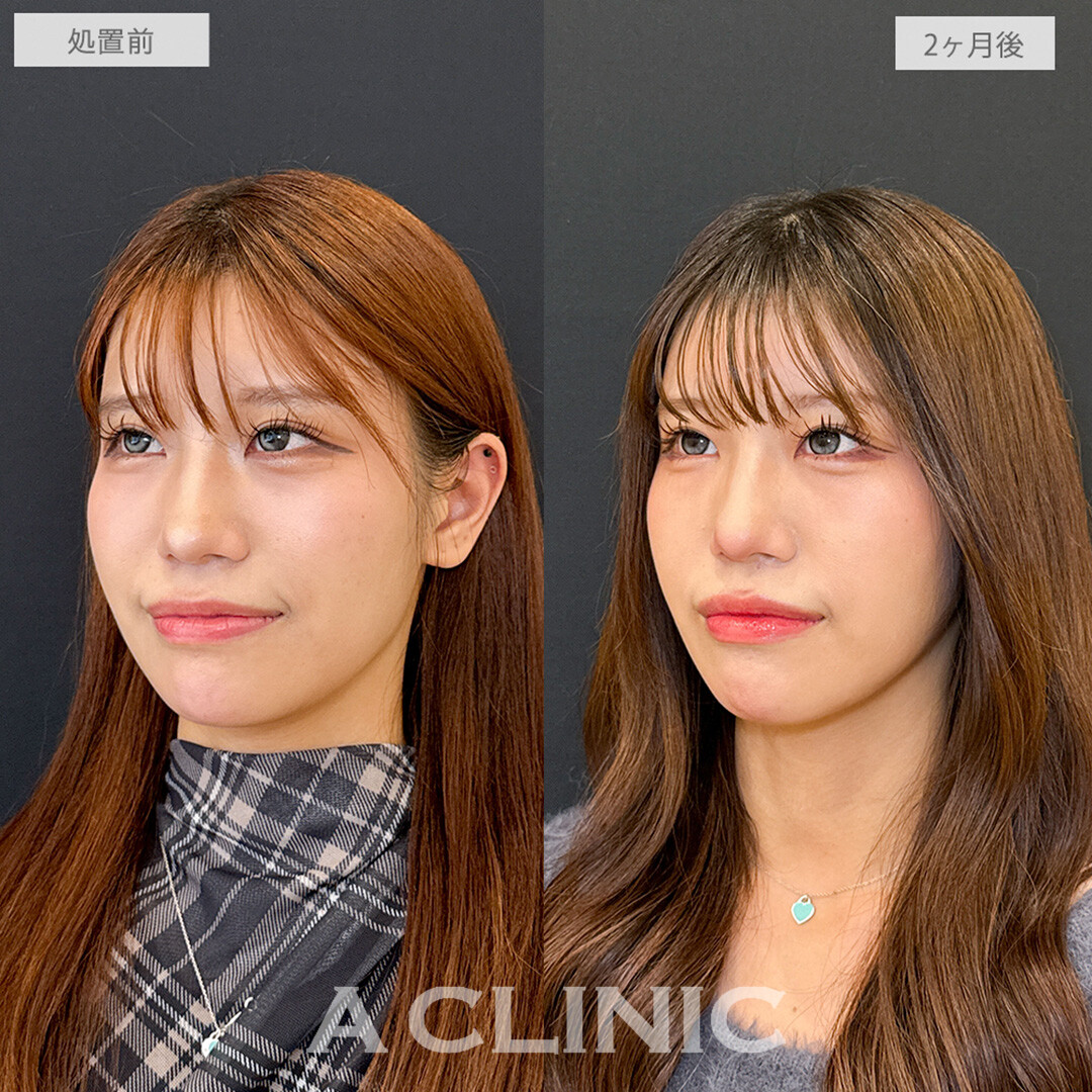 1day小顔脂肪吸引でお顔の余白が減って他撮りも盛れる！こちら処置前と2ヶ月後の症例です(20代女性)