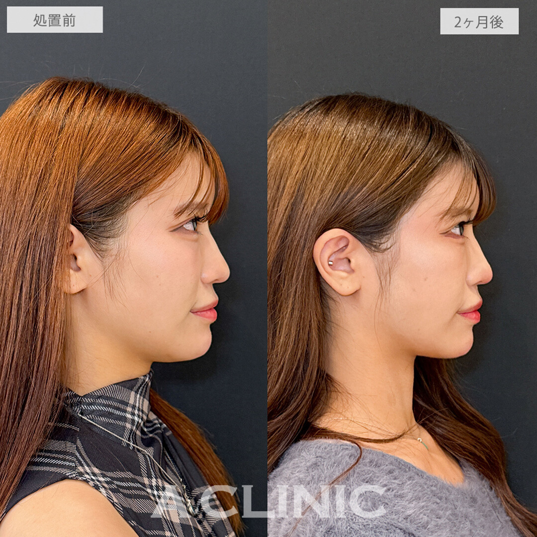 1day小顔脂肪吸引でお顔の余白が減って他撮りも盛れる！こちら処置前と2ヶ月後の症例です(20代女性)