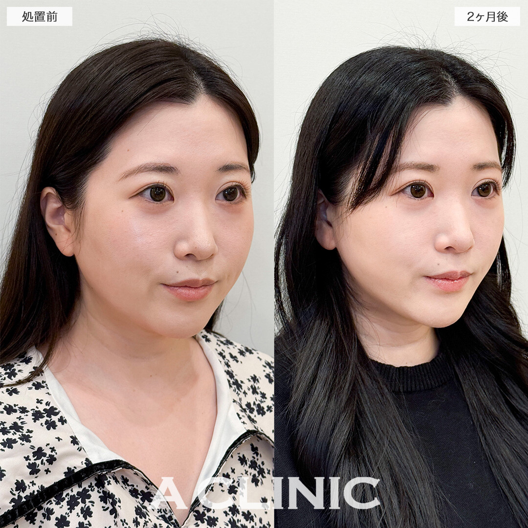 1day小顔脂肪吸引で下を向いた時に気になっていた顎下の脂肪が無くなりました！処置前と2ヶ月後の症例です(30代女性)