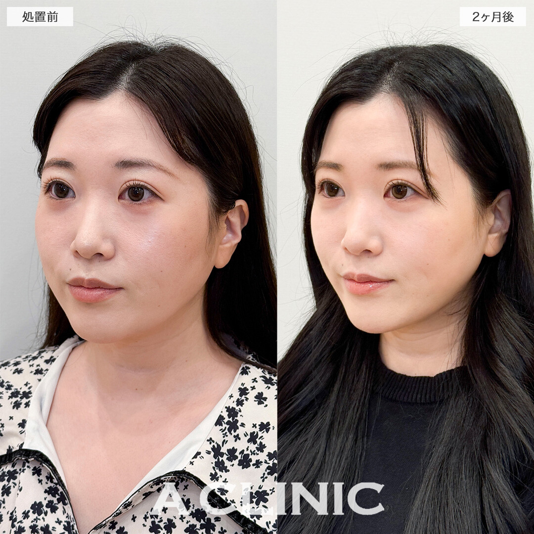 1day小顔脂肪吸引で下を向いた時に気になっていた顎下の脂肪が無くなりました！処置前と2ヶ月後の症例です(30代女性)