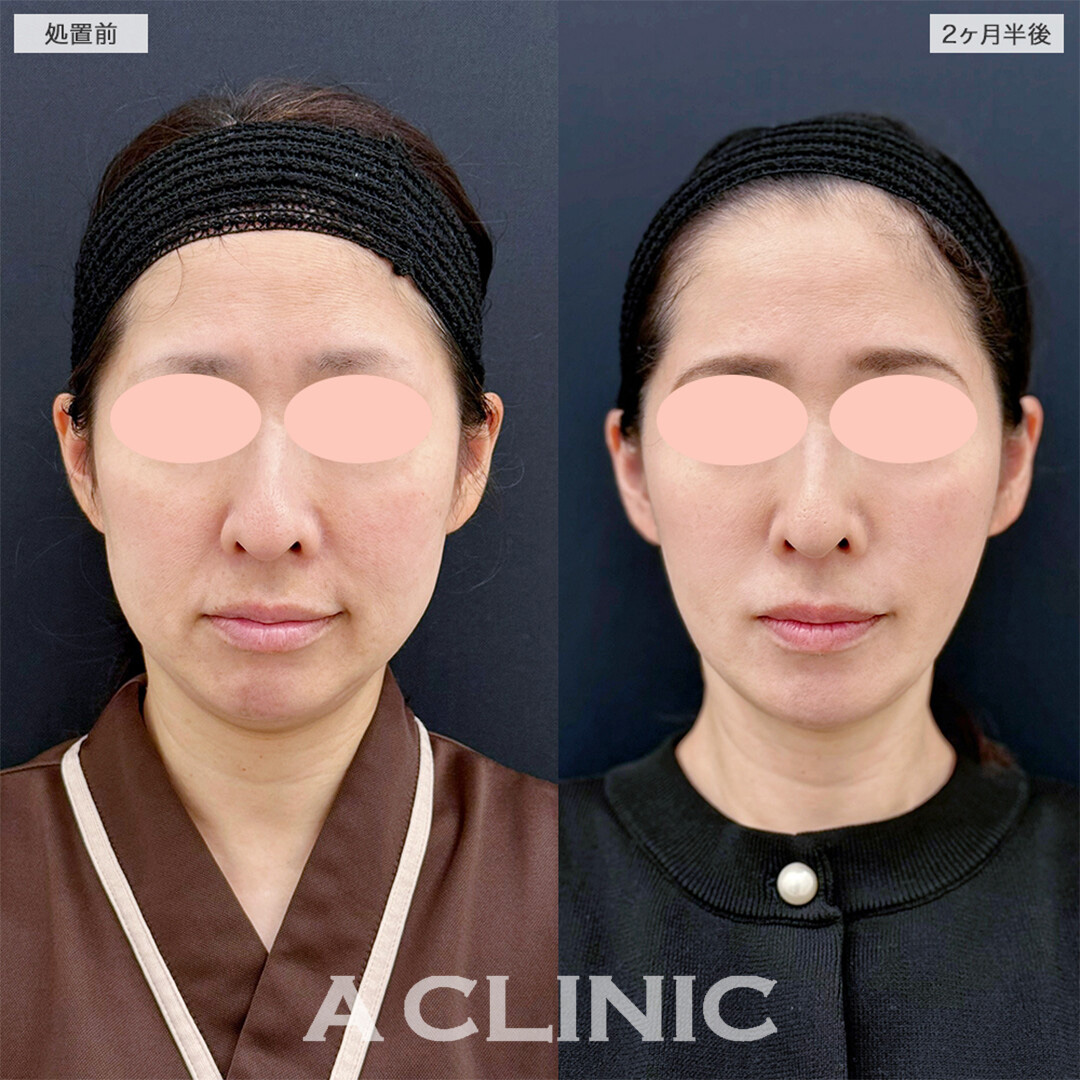 1day小顔脂肪吸引と小顔エラボトックスでボリュームがなくなり自信が持てました！こちら処置前と2ヶ月半後の症例です(40代女性)