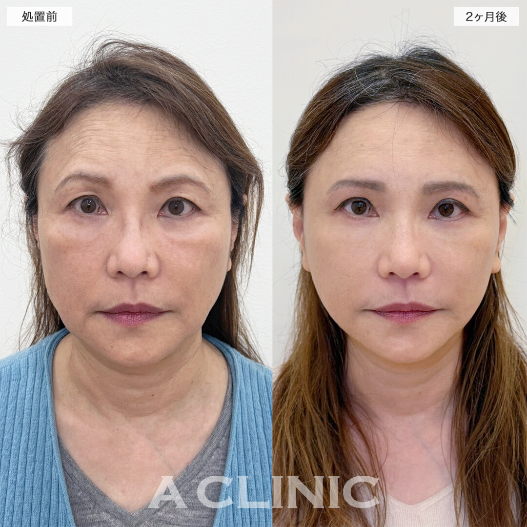 A式美肌たるみ切開と複合施術でシワやたるみ全て解決！こちら処置前と2ヶ月後の症例です(60代女性)