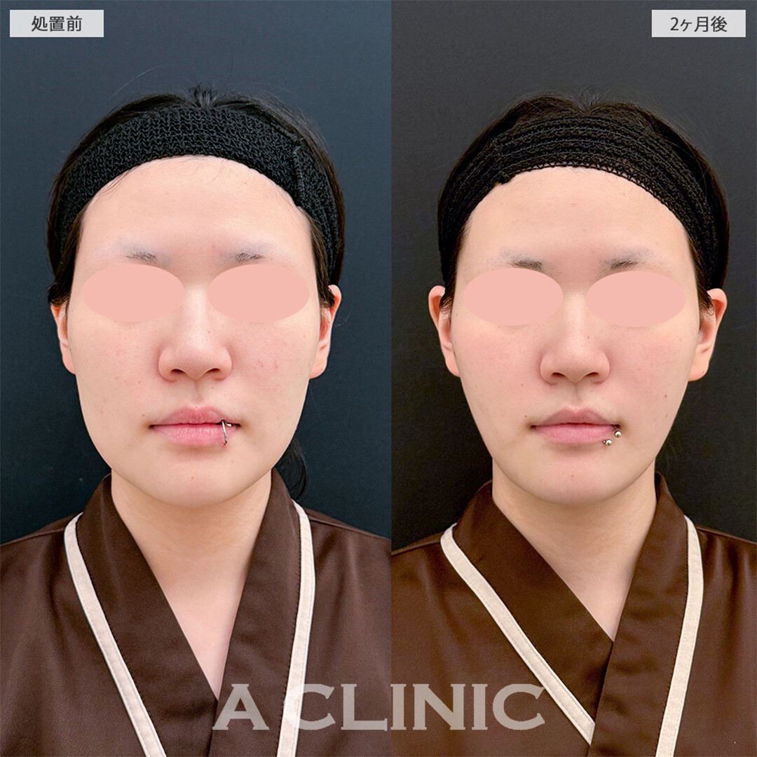 1day小顔脂肪吸引と小顔エラボトックスの組み合わせは小顔最強施術です！こちら処置前と2ヶ月後の症例です(10代女性)