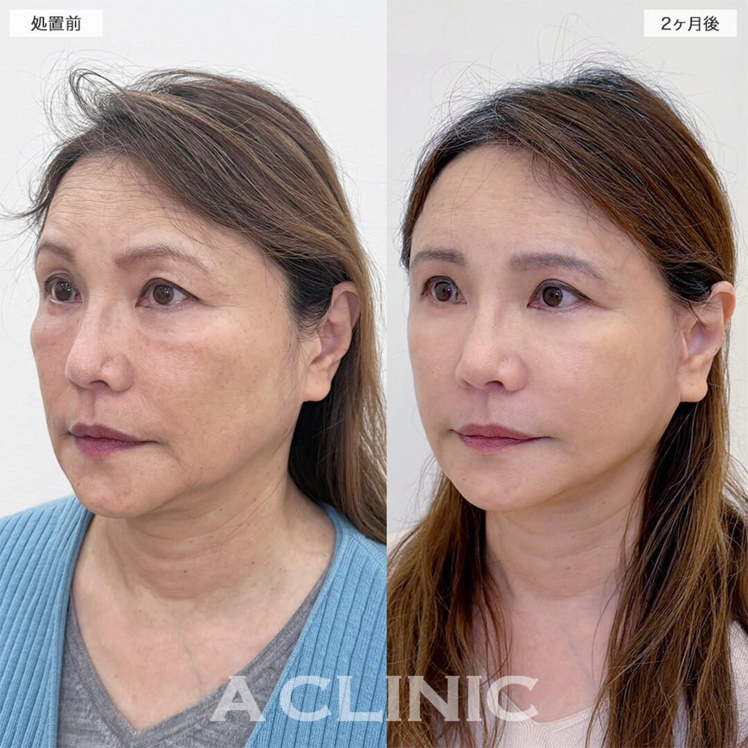A式美肌たるみ切開と複合施術でシワやたるみ全て解決！こちら処置前と2ヶ月後の症例です(60代女性)