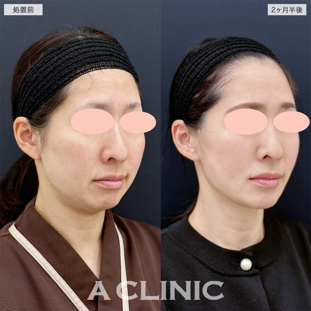 1day小顔脂肪吸引と小顔エラボトックスでボリュームがなくなり自信が持てました！こちら処置前と2ヶ月半後の症例です(40代女性)
