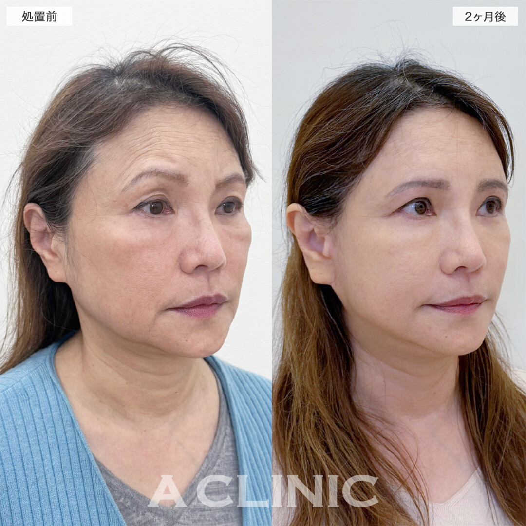 A式美肌たるみ切開と複合施術でシワやたるみ全て解決！こちら処置前と2ヶ月後の症例です(60代女性)