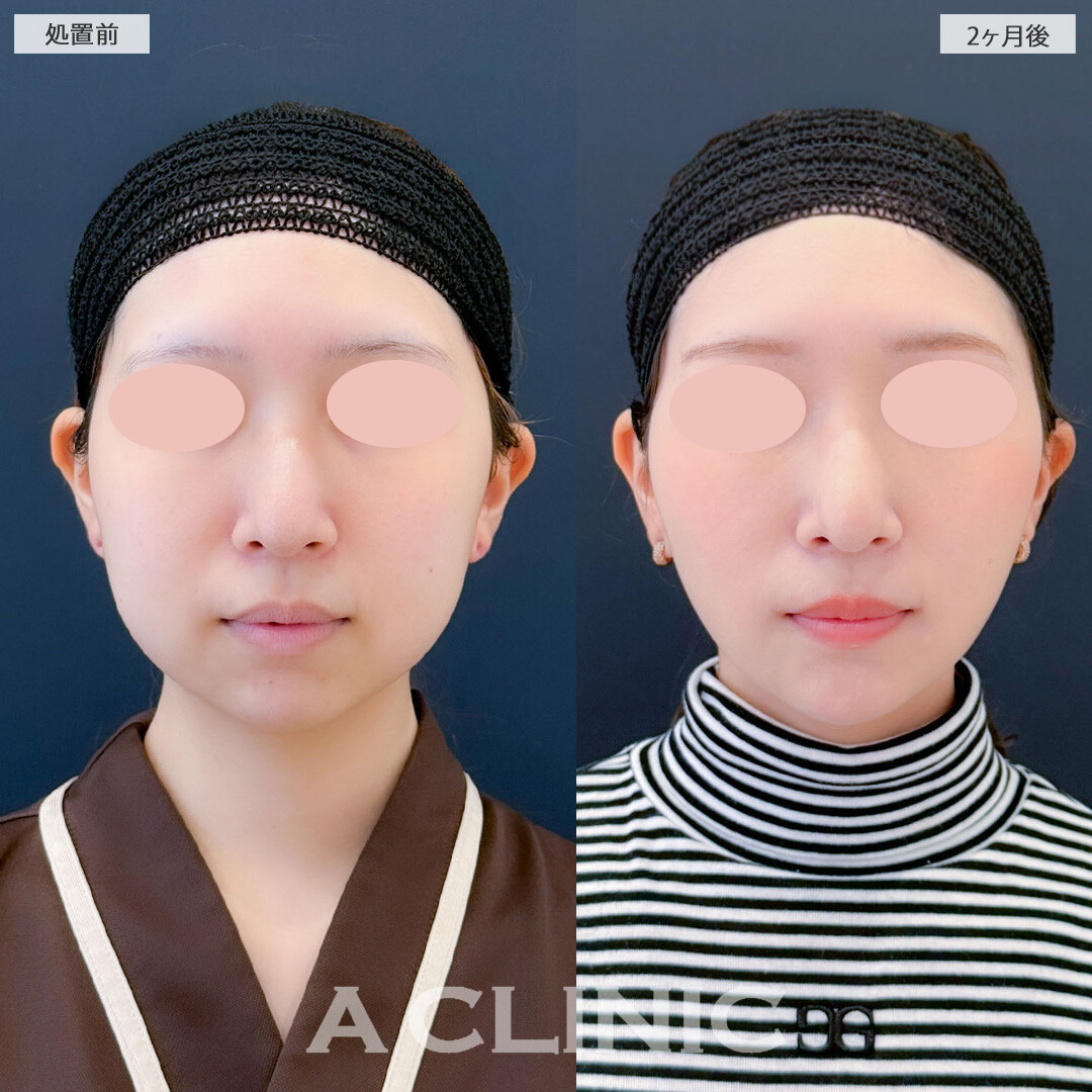 1day小顔脂肪吸引とバッカルファット除去術と小顔エラボトックスにあごへのヒアルロン酸注入で輪郭を整え一回り以上小顔になりました！こちら処置前と2ヶ月後の症例です(20代女性)