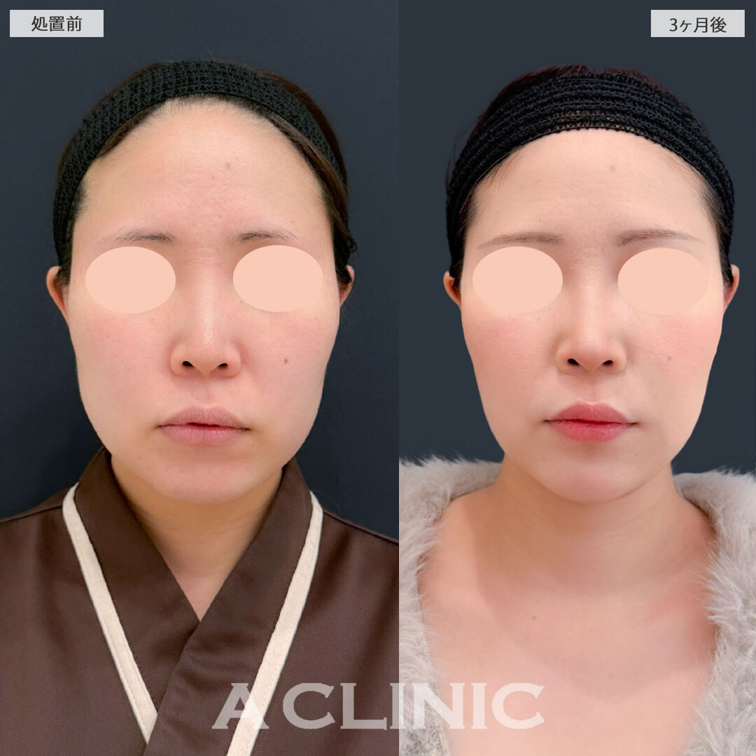 1day小顔脂肪吸引と小顔エラボトックスで気になるエラ下の脂肪がスッキリしました！こちら処置前と3ヶ月後の症例です(30代女性)
