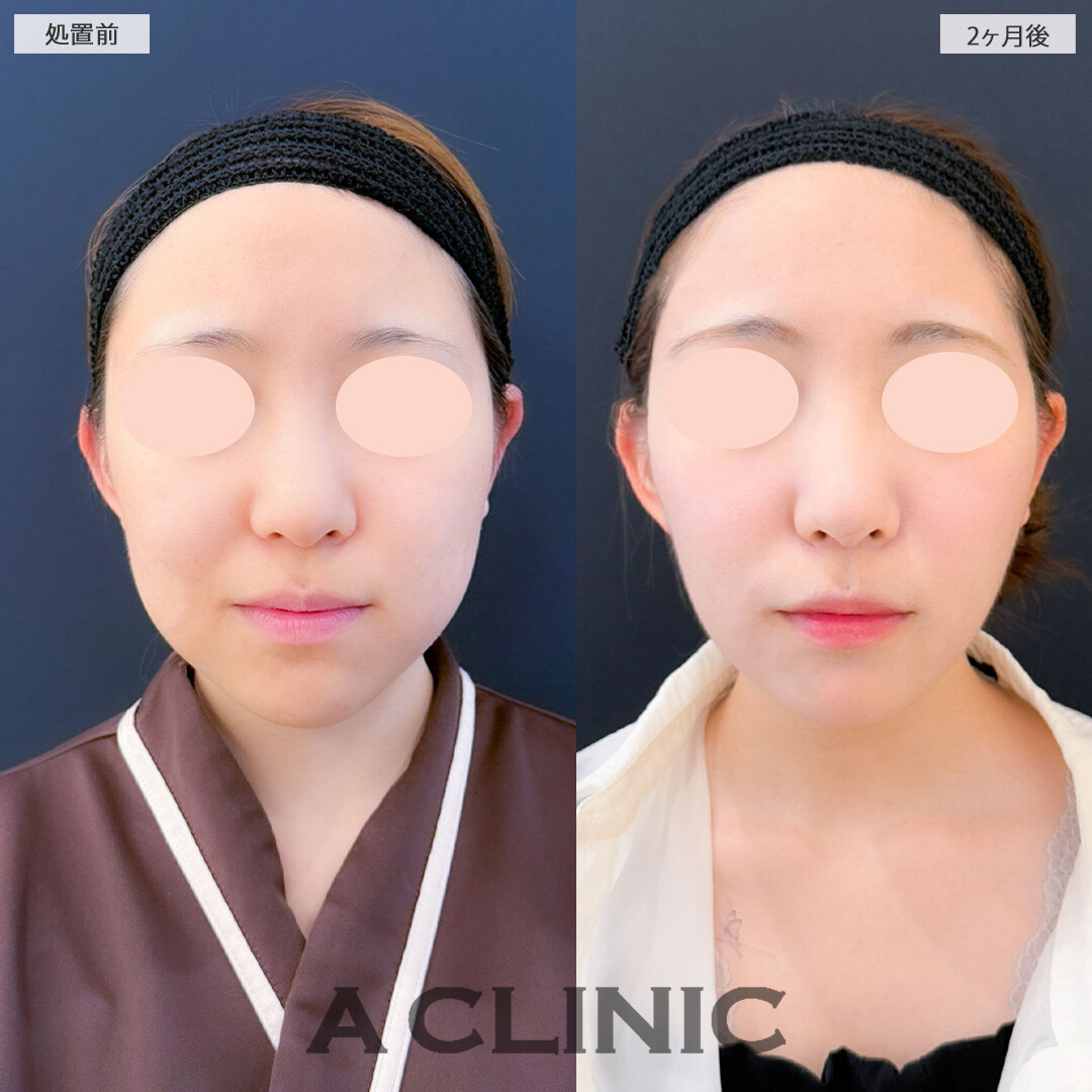 1day小顔脂肪吸引とバッカルファット除去術と小顔エラボトックスで顔のもたつきを解消しスッキリフェイスに！こちら処置前と2ヶ月後の症例です(20代女性)