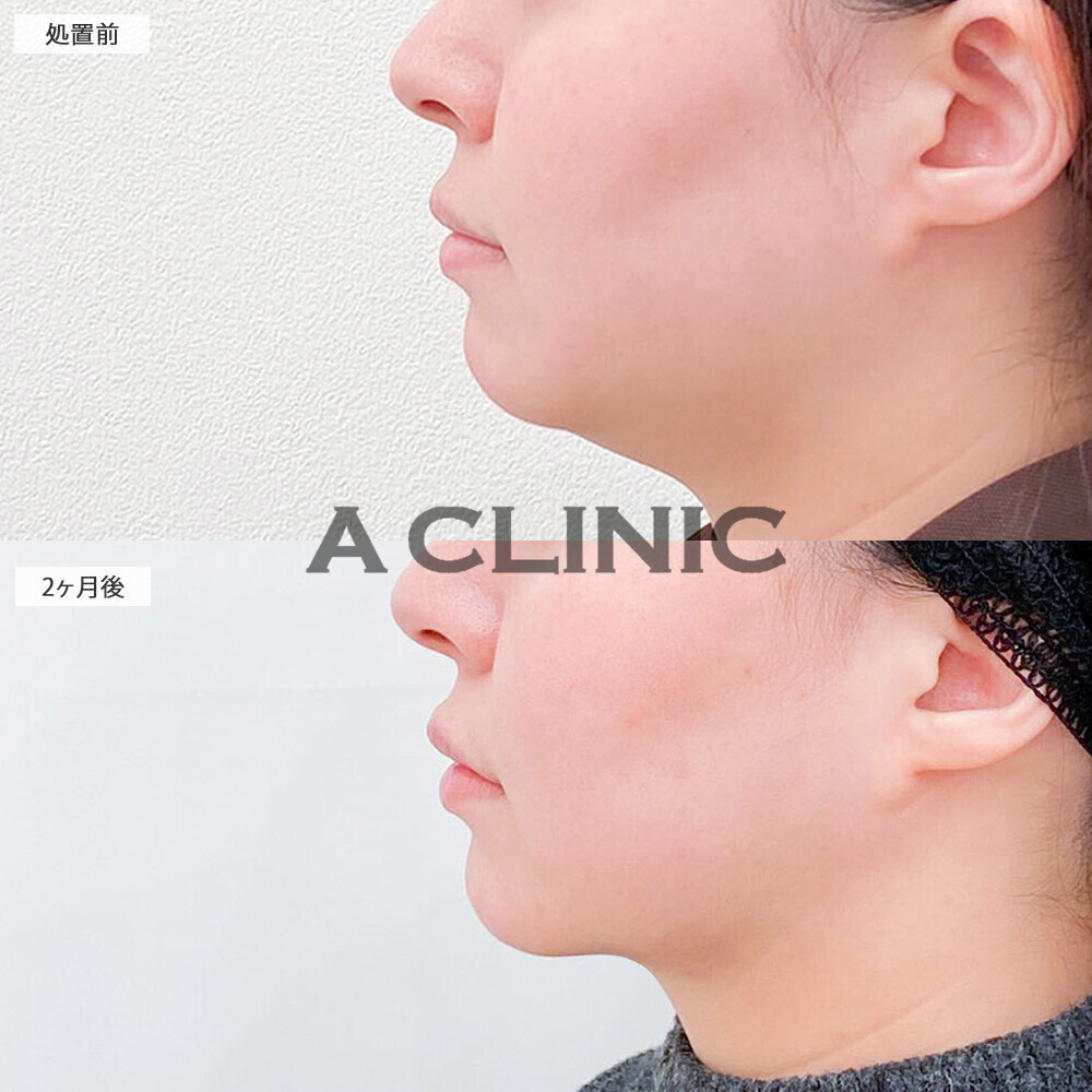 1day小顔脂肪吸引で二重アゴにならないスッキリ横顔に！こちら処置前から2ヶ月後の症例です(30代女性)