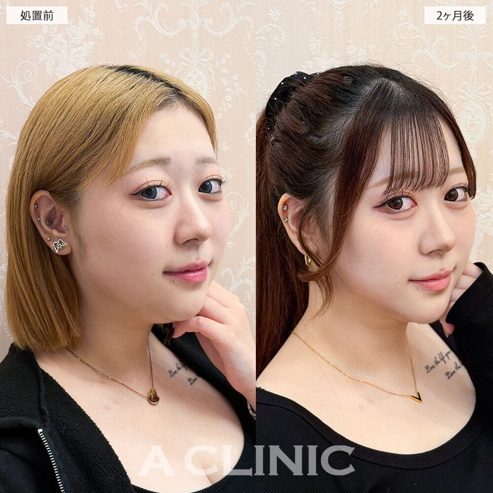 1day小顔脂肪吸引で見違える程輪郭がスッキリしました！こちら処置前と2ヶ月後の症例です(10代女性)