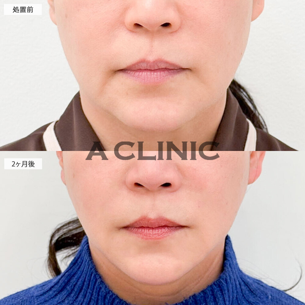 1day小顔脂肪吸引で10歳若返り！処置前から2ヶ月後の症例です(50代女性)