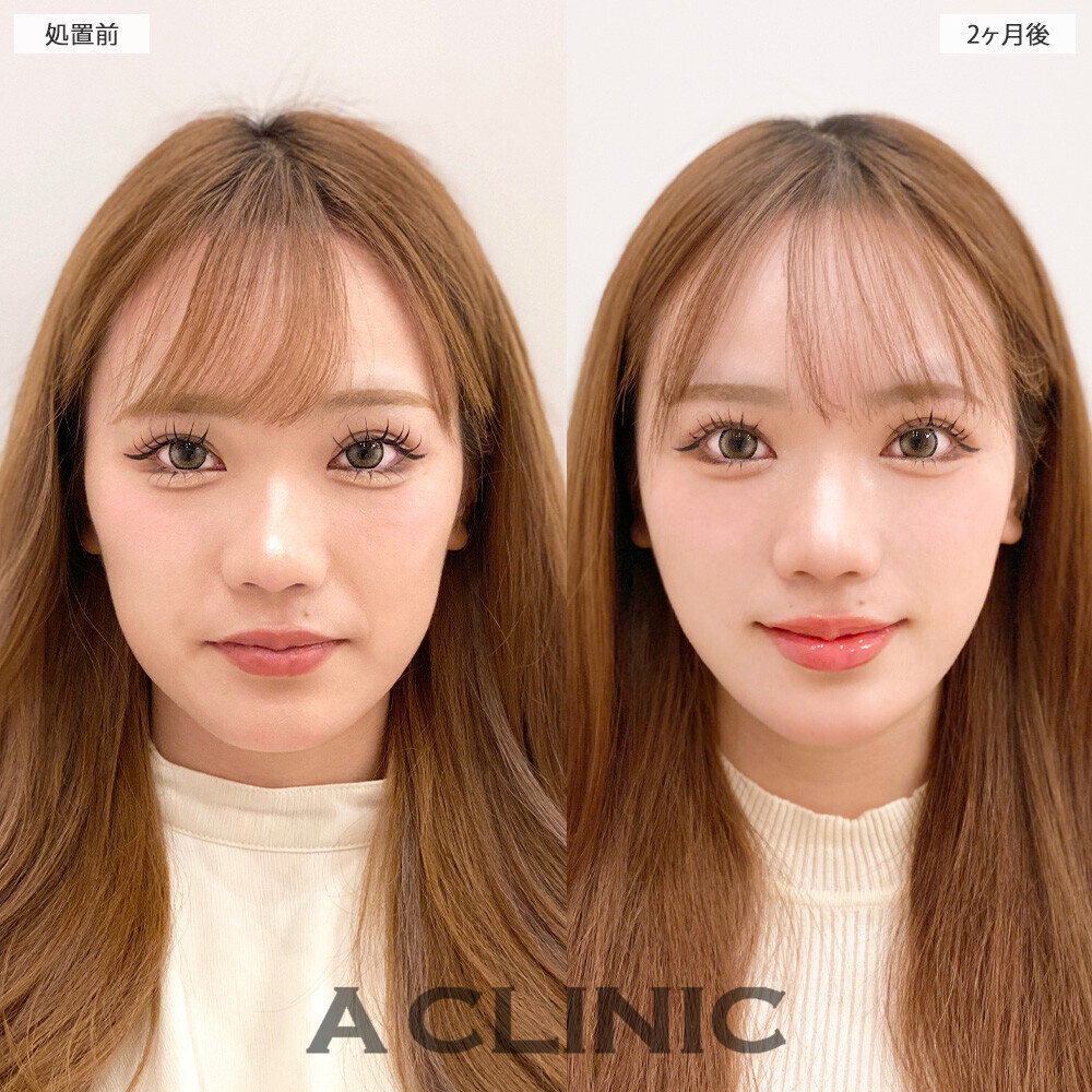 1day小顔脂肪吸引で顔の四角さがなくなり垢抜けました！こちら処置前から2ヶ月後の症例です(20代女性)