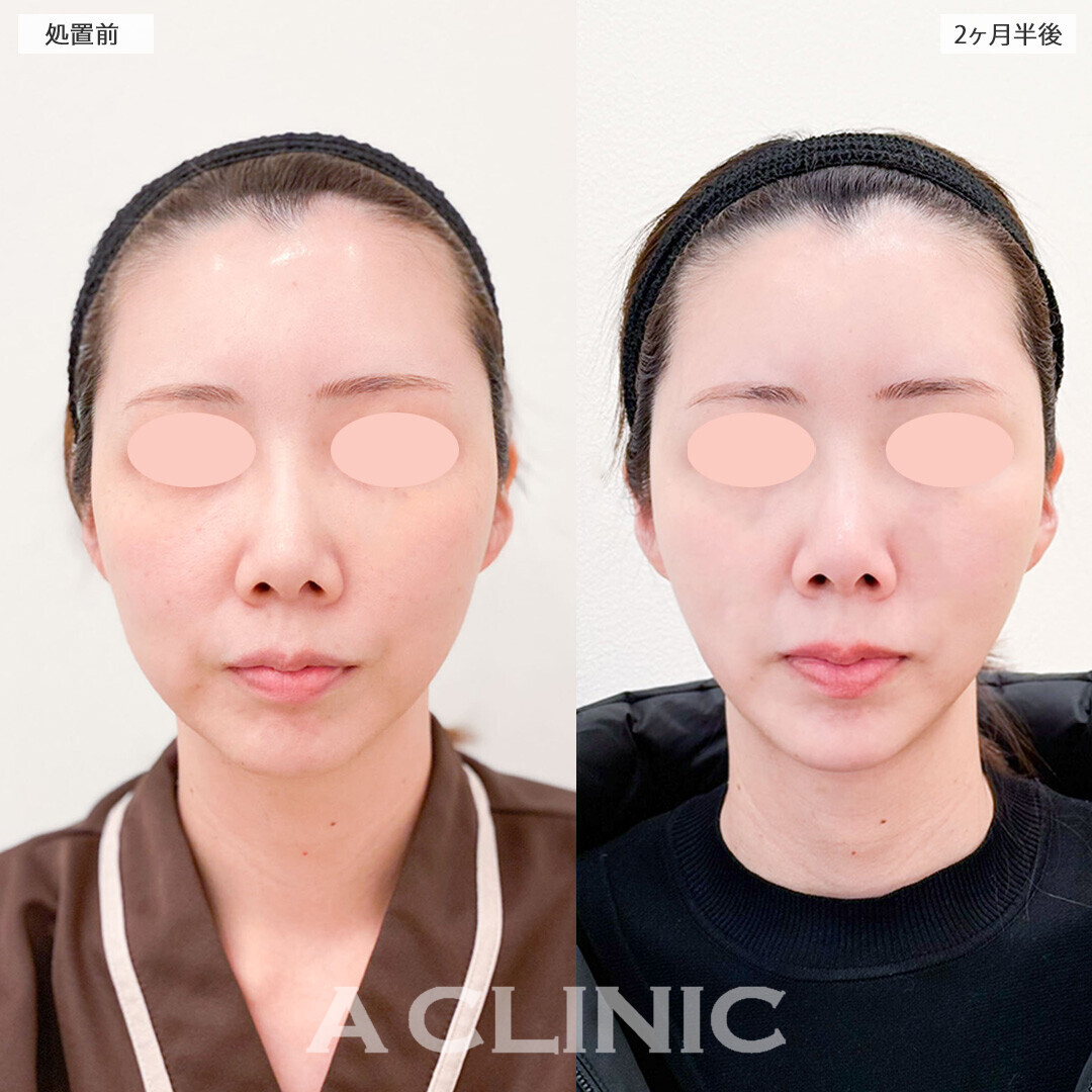 1day小顔脂肪吸引ならダイエットしても残りやすいあご下の脂肪もスッキリ！処置前から2ヶ月後の症例です(20代女性)