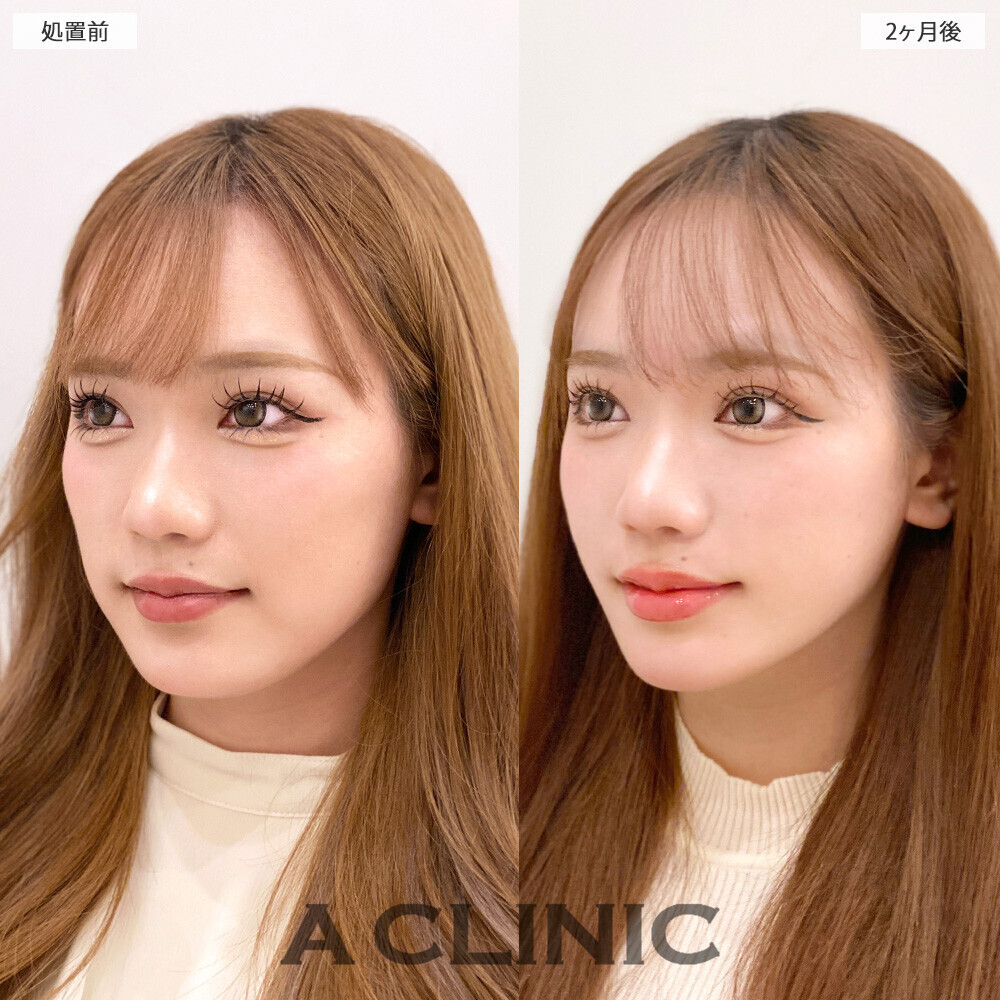 1day小顔脂肪吸引で顔の四角さがなくなり垢抜けました！こちら処置前から2ヶ月後の症例です(20代女性)