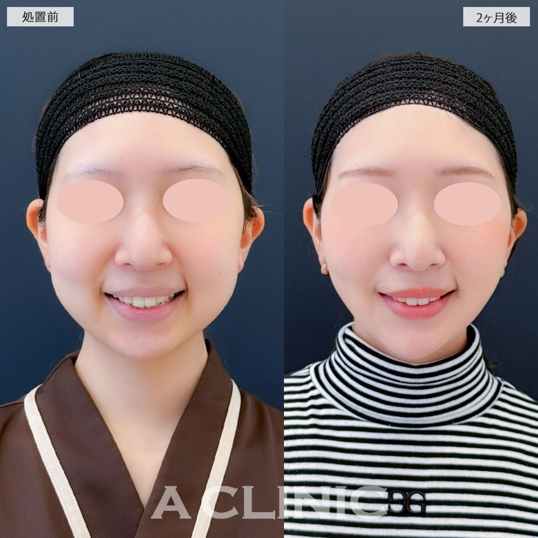 1day小顔脂肪吸引とバッカルファット除去術と小顔エラボトックスにあごへのヒアルロン酸注入で輪郭を整え一回り以上小顔になりました！こちら処置前と2ヶ月後の症例です(20代女性)