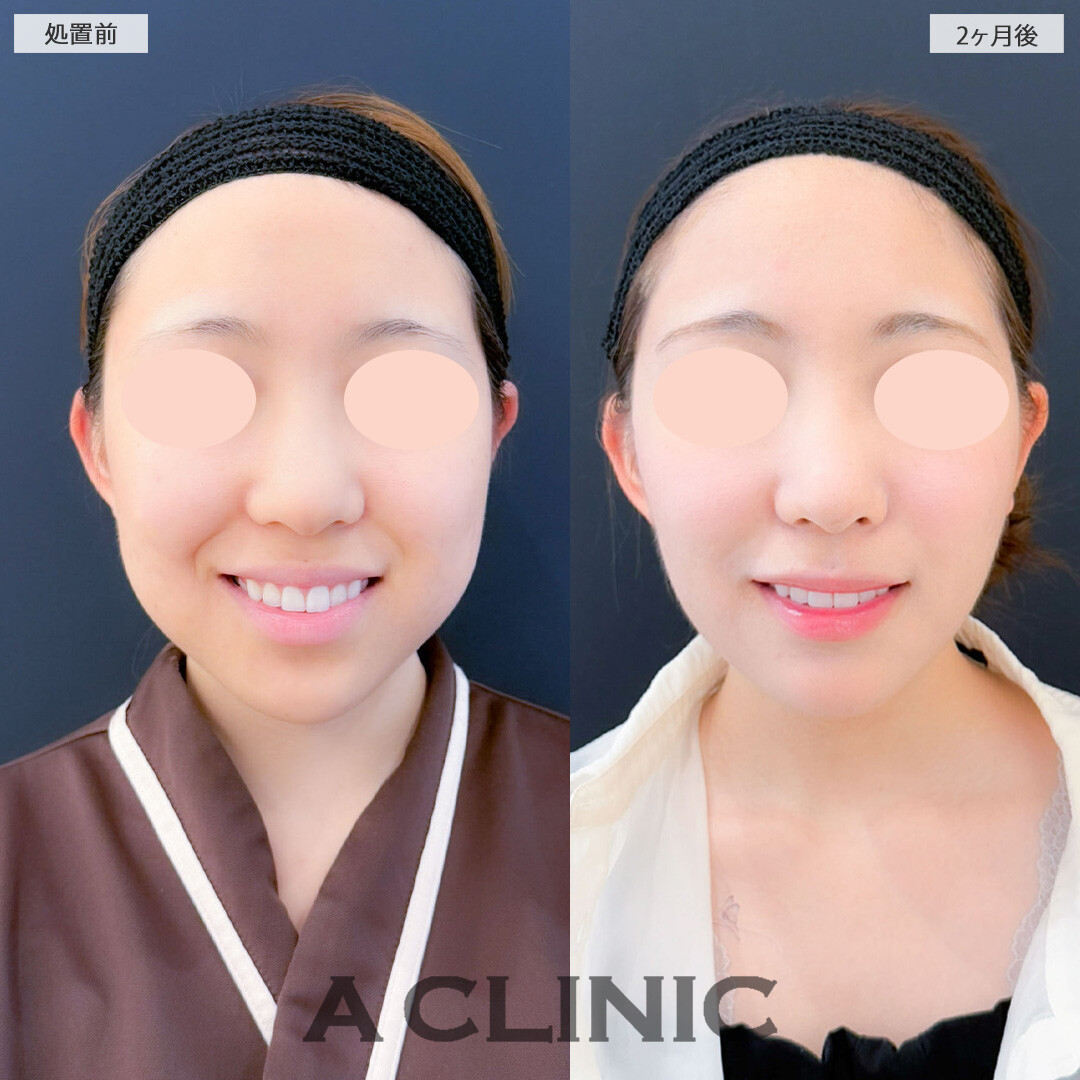 1day小顔脂肪吸引とバッカルファット除去術と小顔エラボトックスで顔のもたつきを解消しスッキリフェイスに！こちら処置前と2ヶ月後の症例です(20代女性)
