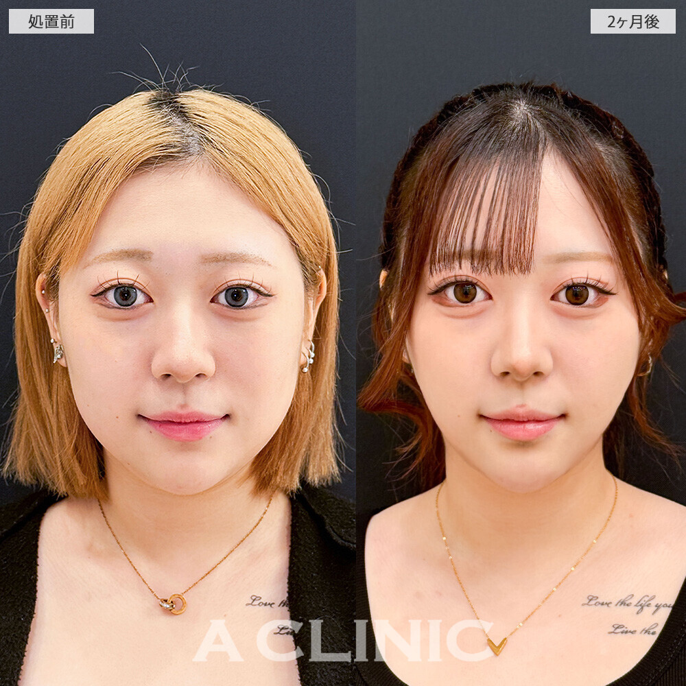 1day小顔脂肪吸引で見違える程輪郭がスッキリしました！こちら処置前と2ヶ月後の症例です(10代女性)