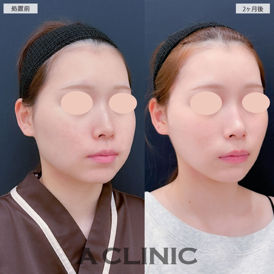 1day小顔脂肪吸引とバッカルファット除去術と小顔エラボトックスで輪郭がスッキリ小顔になりました！こちら処置前と2ヶ月後の症例です(20代女性)