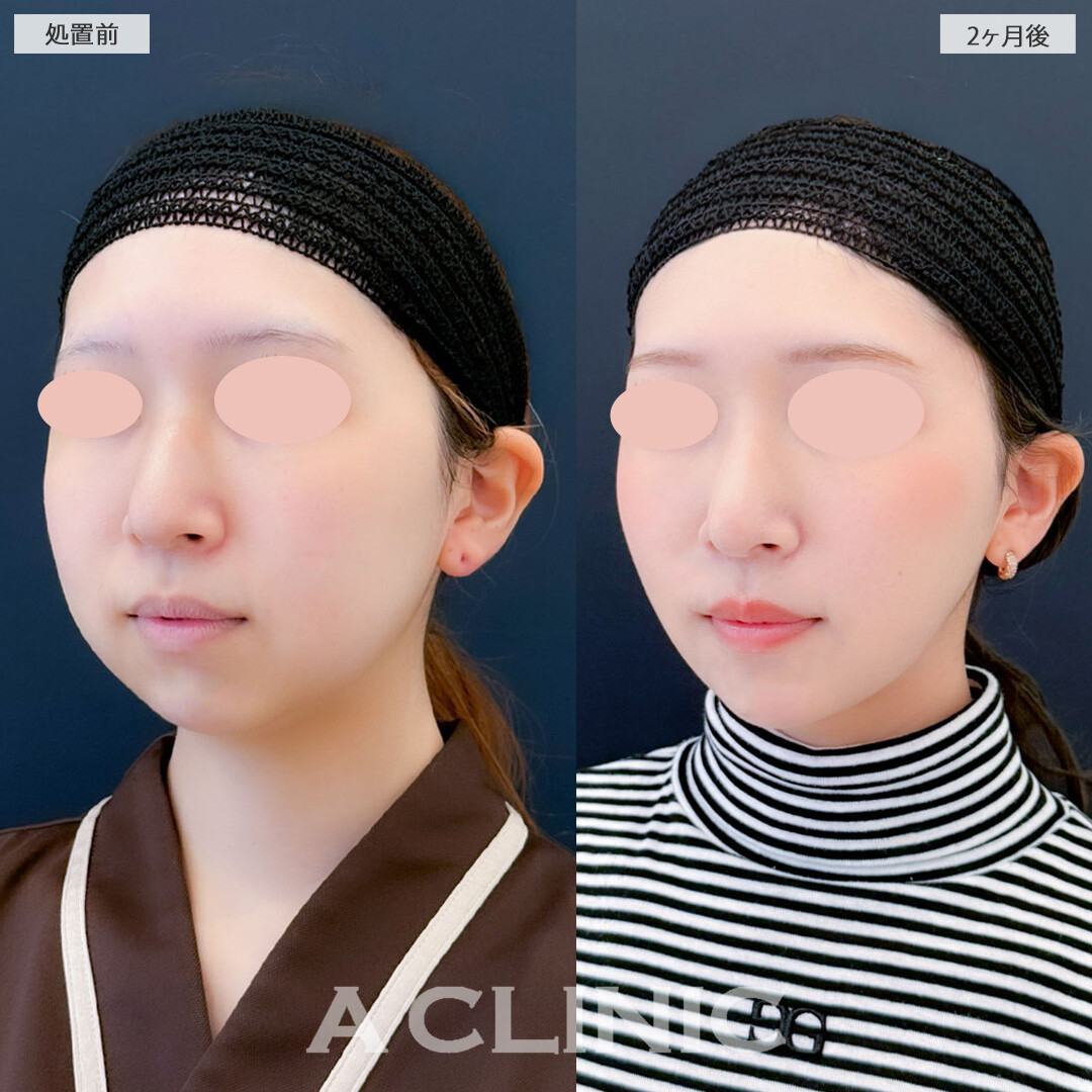 1day小顔脂肪吸引とバッカルファット除去術と小顔エラボトックスにあごへのヒアルロン酸注入で輪郭を整え一回り以上小顔になりました！こちら処置前と2ヶ月後の症例です(20代女性)