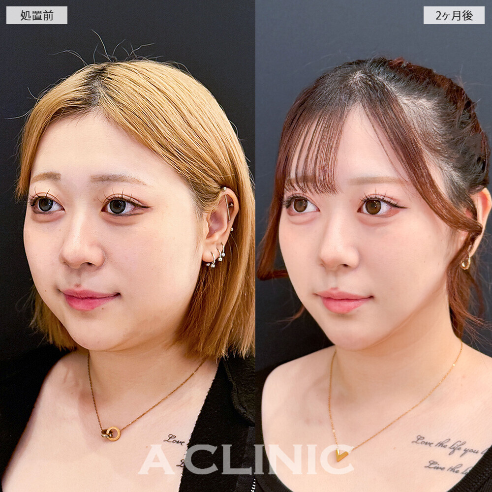 1day小顔脂肪吸引で見違える程輪郭がスッキリしました！こちら処置前と2ヶ月後の症例です(10代女性)