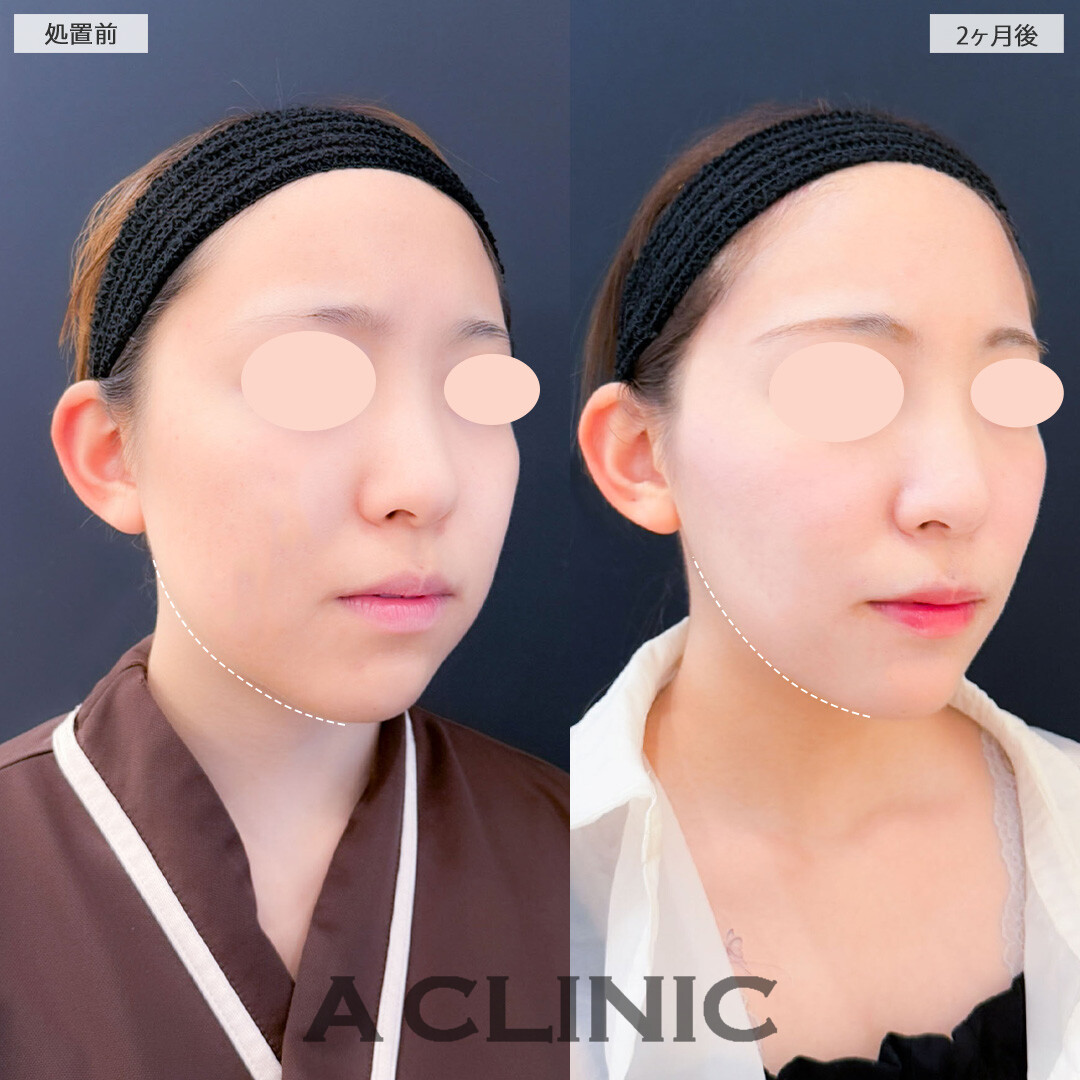 1day小顔脂肪吸引とバッカルファット除去術と小顔エラボトックスで顔のもたつきを解消しスッキリフェイスに！こちら処置前と2ヶ月後の症例です(20代女性)