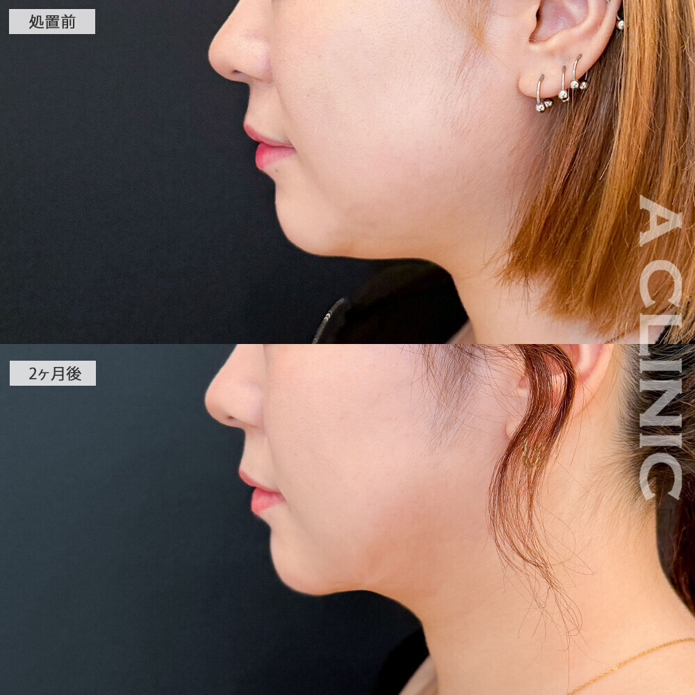 1day小顔脂肪吸引で見違える程輪郭がスッキリしました！こちら処置前と2ヶ月後の症例です(10代女性)