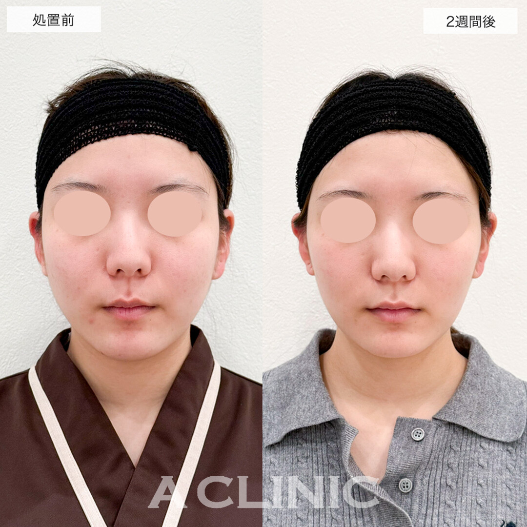 1day小顔脂肪吸引で輪郭のラインがスッキリ見えるように!こちら処置前と2週間後の症例です(20代女性)