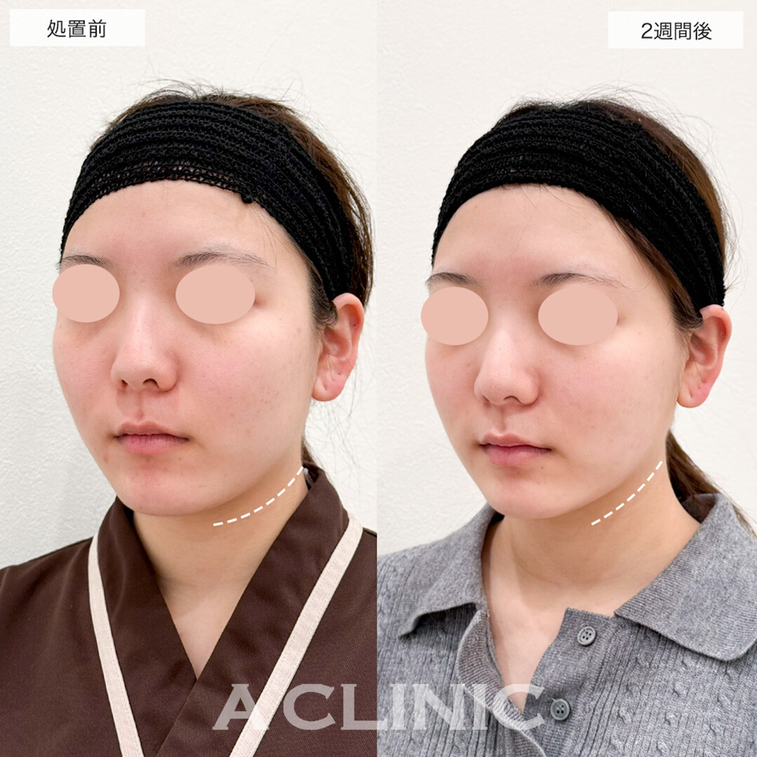 1day小顔脂肪吸引で輪郭のラインがスッキリ見えるように!こちら処置前と2週間後の症例です(20代女性)