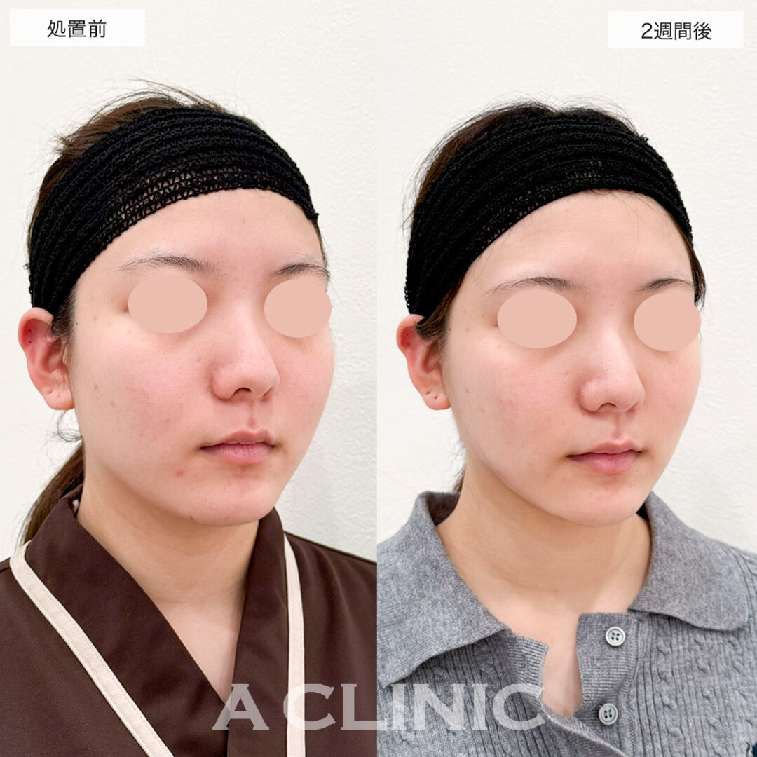 1day小顔脂肪吸引で輪郭のラインがスッキリ見えるように!こちら処置前と2週間後の症例です(20代女性)