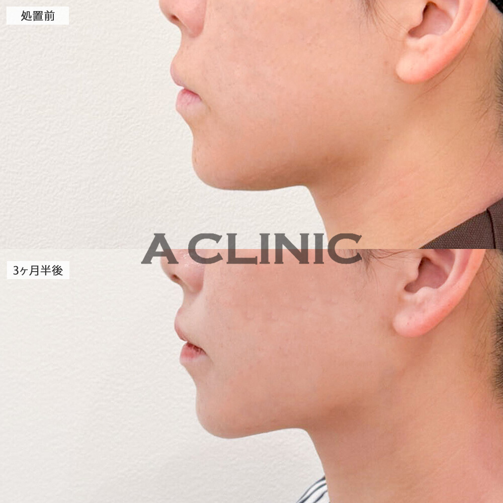 1day小顔脂肪吸引であご下スッキリの綺麗な横顔に！処置前から3ヶ月半後の症例です(20代女性)