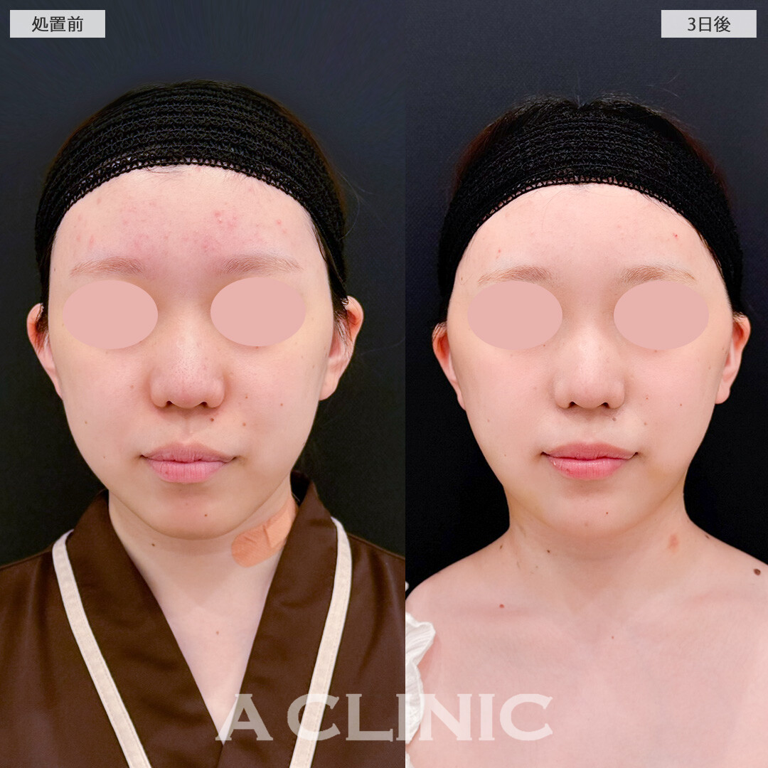 1day小顔脂肪吸引とバッカルファット除去術でダウンタイムのピーク時でも腫れがそんなに目立ちません！処置前と3日後の症例です(10代女性)