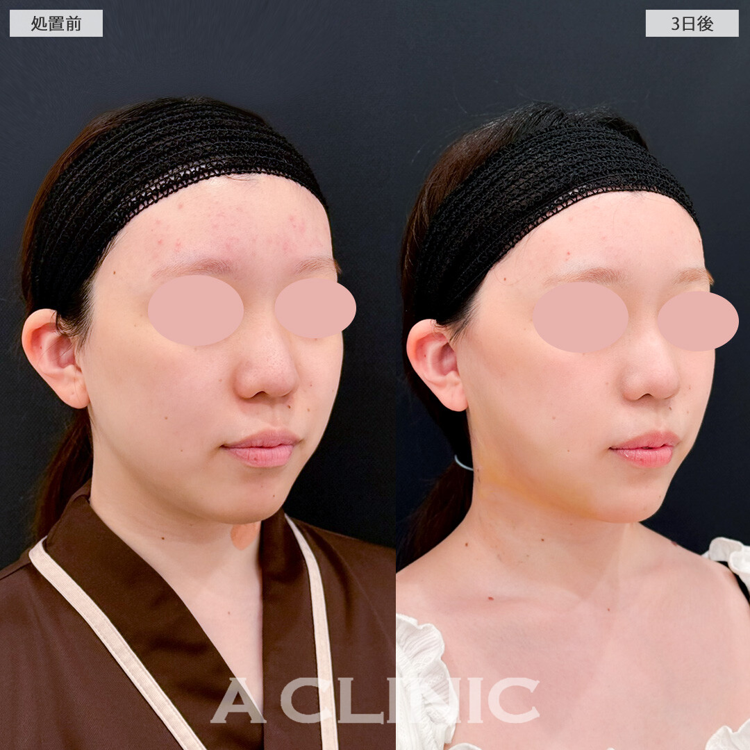 1day小顔脂肪吸引とバッカルファット除去術でダウンタイムのピーク時でも腫れがそんなに目立ちません！処置前と3日後の症例です(10代女性)