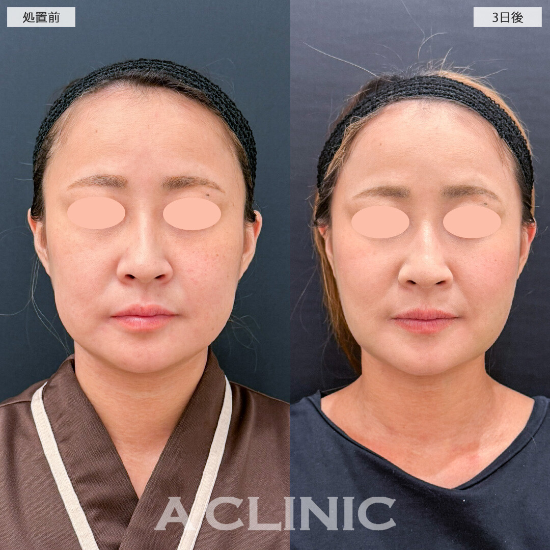 バッカルファット除去術から3日後でも腫れが少なく外出できちゃいます！こちら処置前と3日後の症例です(30代女性)