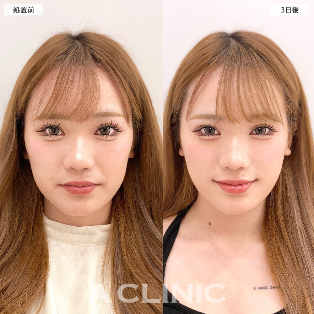 1day小顔脂肪吸引で顔の四角さがなくなり垢抜けました！こちら処置前から2ヶ月後の症例です(20代女性)