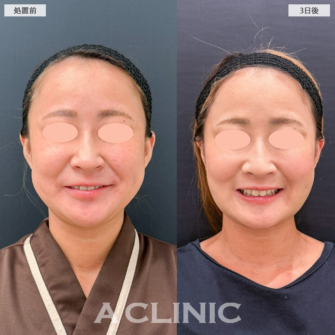 バッカルファット除去術から3日後でも腫れが少なく外出できちゃいます！こちら処置前と3日後の症例です(30代女性)