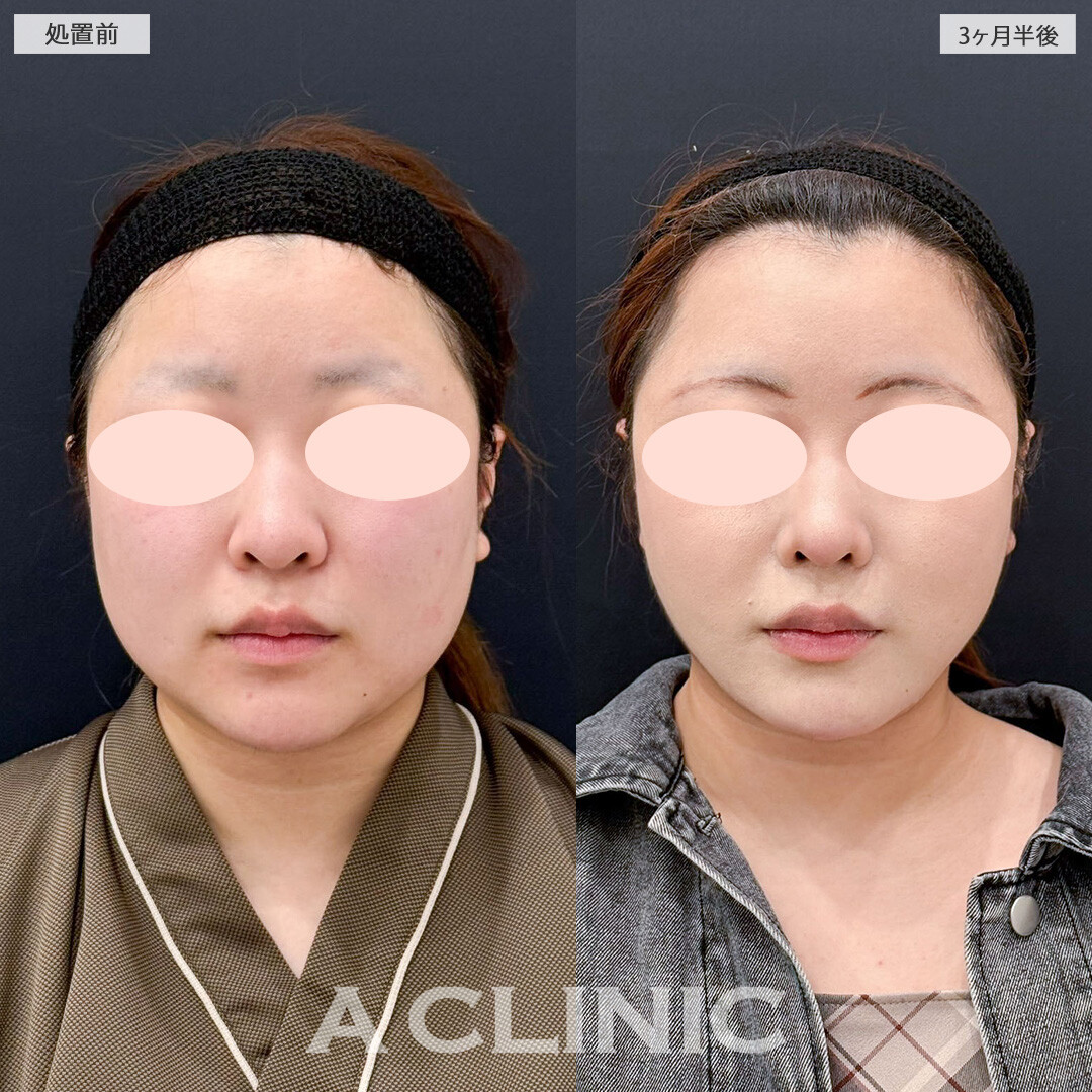 1day小顔脂肪吸引で気になっていた口横ポニョが改善し輪郭美人になりました！こちら処置前と3ヶ月半後の症例です(20代女性)