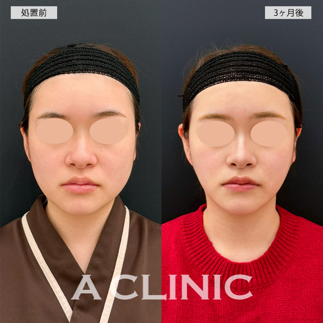 1day小顔脂肪吸引と小顔エラボトックスで加工いらずの輪郭に！こちら処置前と3ヶ月後の症例です(20代女性)