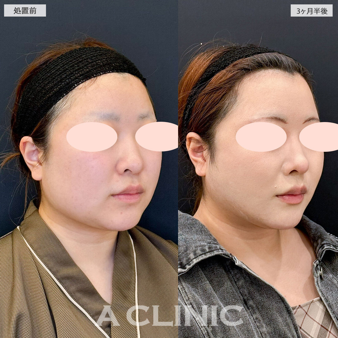 1day小顔脂肪吸引で気になっていた口横ポニョが改善し輪郭美人になりました！こちら処置前と3ヶ月半後の症例です(20代女性)