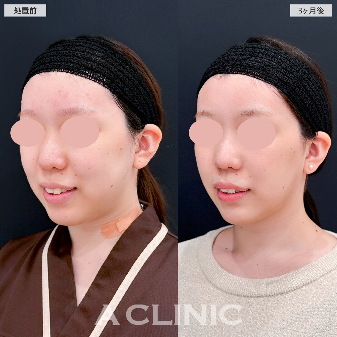 1day小顔脂肪吸引とバッカルファット除去術で輪郭の歪みを整えシャープなフェイスラインに！処置前と3ヶ月後の症例です(10代女性)