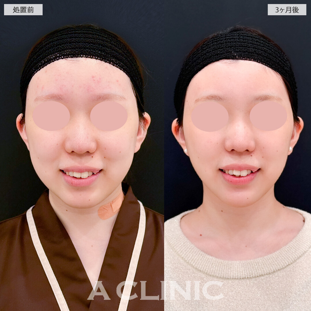 1day小顔脂肪吸引とバッカルファット除去術で輪郭の歪みを整えシャープなフェイスラインに！処置前と3ヶ月後の症例です(10代女性)