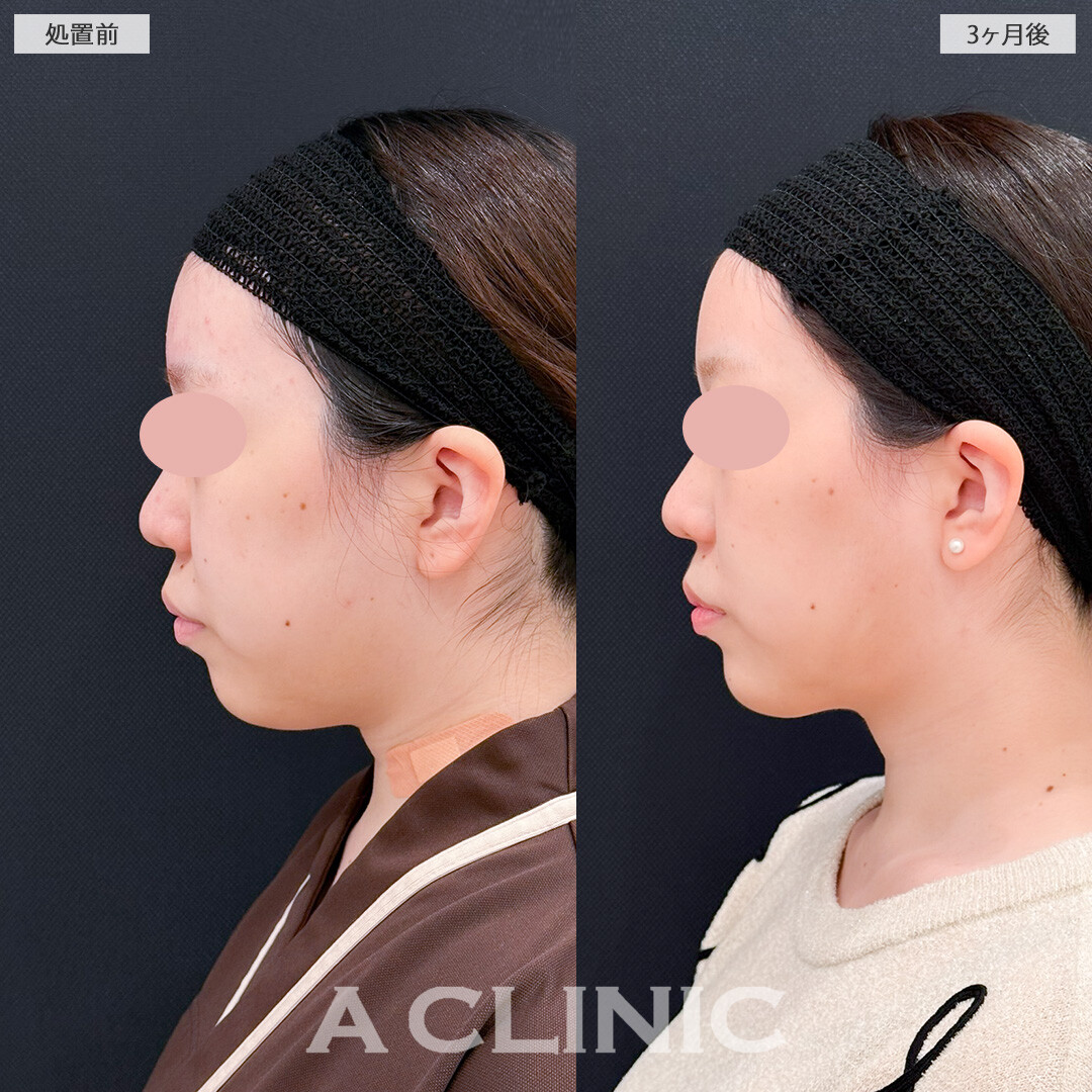 1day小顔脂肪吸引とバッカルファット除去術で輪郭の歪みを整えシャープなフェイスラインに！処置前と3ヶ月後の症例です(10代女性)