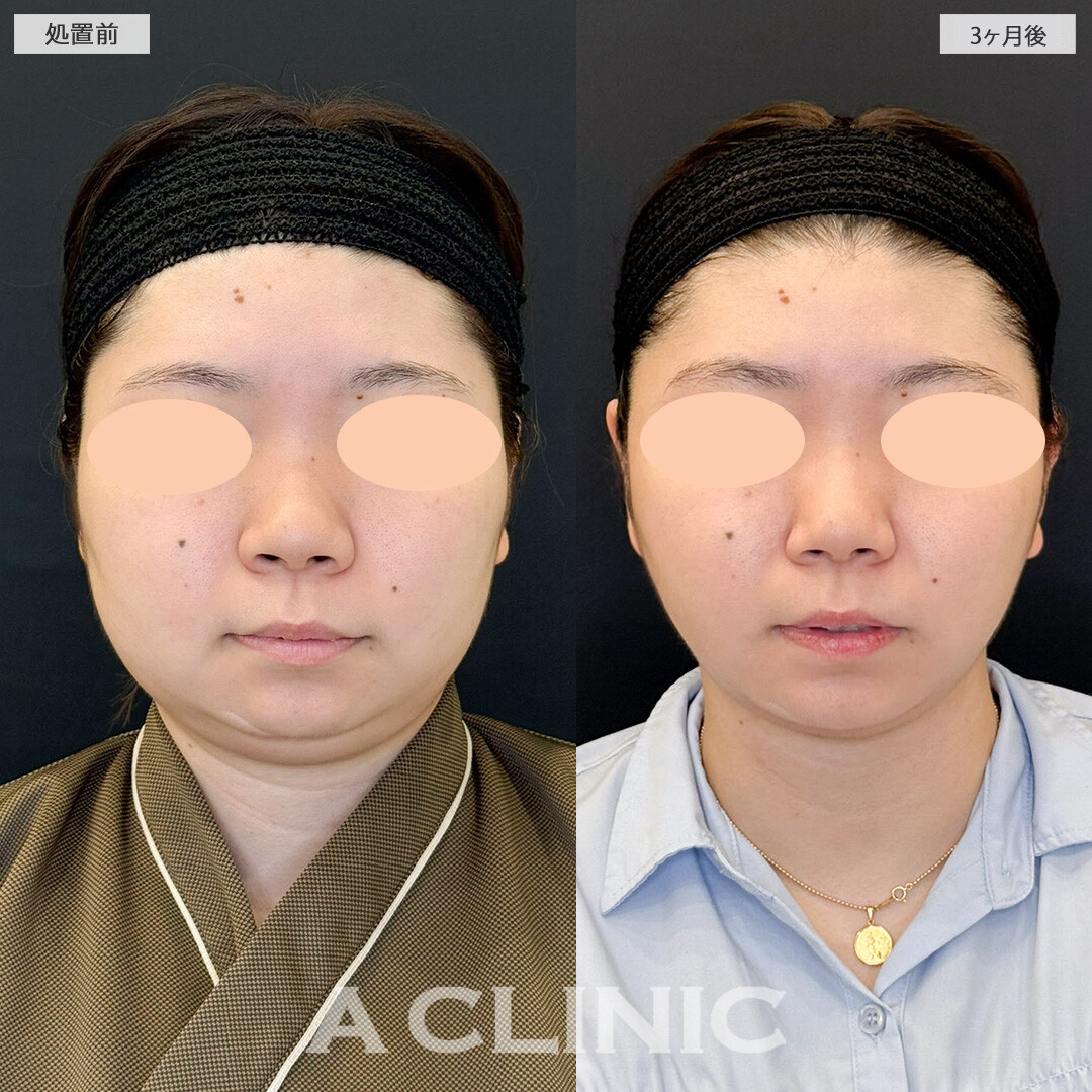 1day小顔脂肪吸引で気になっていた二重あご改善し小顔になりました！こちら処置前と3ヶ月後の症例です(20代女性)