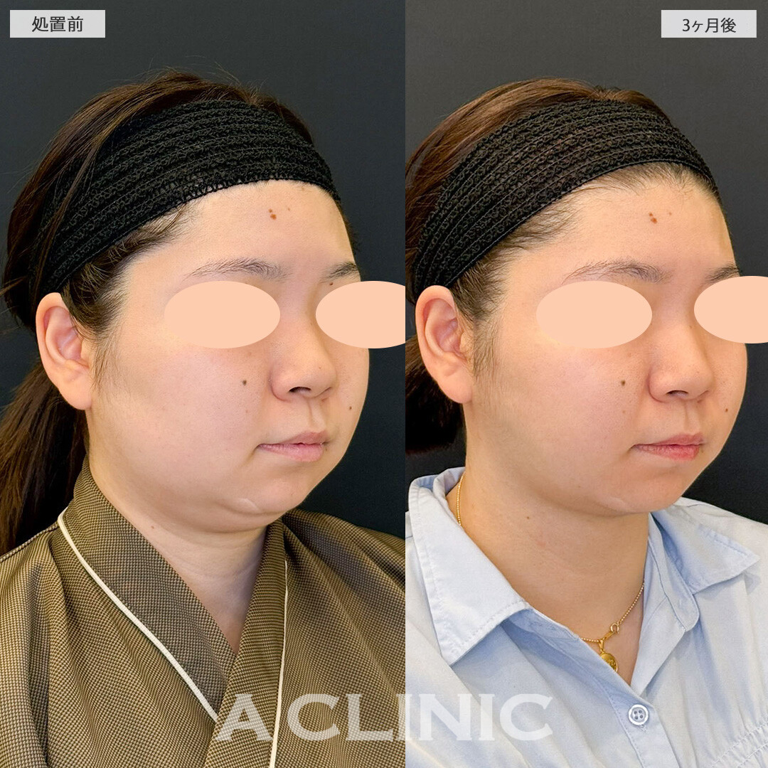 1day小顔脂肪吸引で気になっていた二重あご改善し小顔になりました！こちら処置前と3ヶ月後の症例です(20代女性)